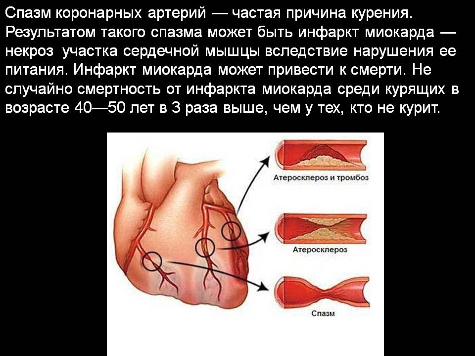 Почему происходят спазмы. Спазм коронарных артерий. Причины спазма коронарных артерий. Спазм венечных артерий. Спазм коронарных артерий причины.