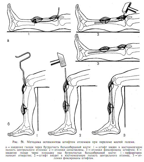 Разрабатываем ногу после операции. Переломы (для ускорения консолидации костных отломков);. Интрамедуллярный остеосинтез большеберцовой кости. Экстрамедуллярный остеосинтез голени.